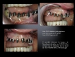 implant ankylos zircone